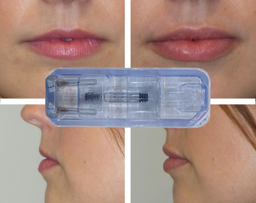 CE Injectavel Com Enchimento de Ácido Hyalurónico Cruzado Injecção Lip 24 mg/ ml