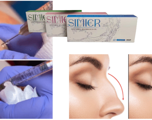 Tratamento de injecção de gel de hialuronato de sódio transparente de 10 ml para preencher as linhas do sorriso