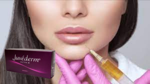 Juvederm Ultra 3 Ácido Hialurónico HA Enchimento Dermológico 2 ml Melhoramento dos Lábios