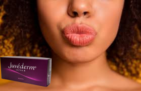 Juvederm Ultra 3 Ácido Hialurónico HA Enchimento Dermológico 2 ml Melhoramento dos Lábios
