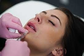 GMP Juvederm Ultra 3 HA Preenchimento dérmico para lábios Juvederm Vollure